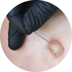 Diabetic foot ulcer on the sole of the foot.